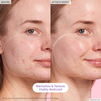 Before-and-after photo of a 30-year-old using Glow Recipe Blackberry Retinol Blemish Serum, showing clarified, even-toned skin.
